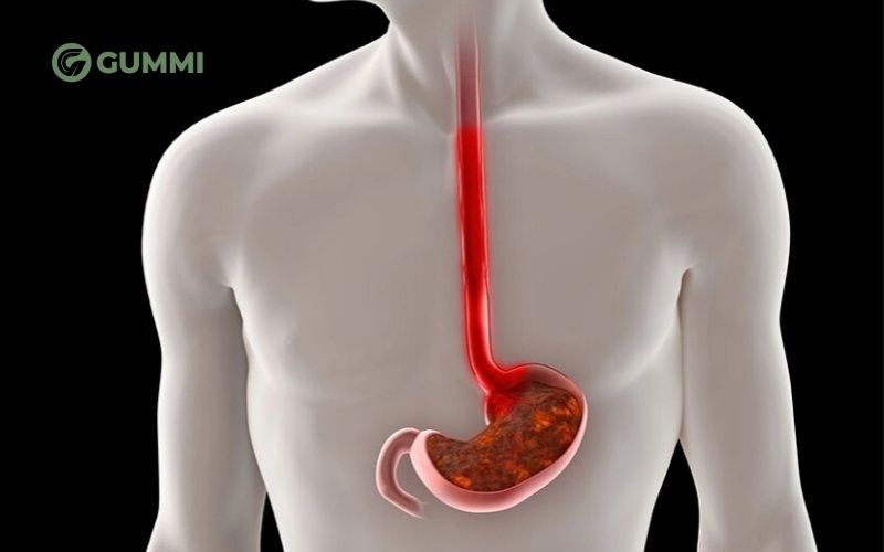 Trào ngược dạ dày là tình trạng axit trào lên thực quản